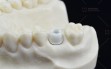 Calypso-Abutment