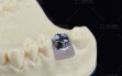 Digitek-titanium-abutment1