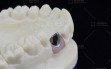 Digitek-titanium-abutment2