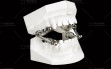 Herbst-Appliance---Cast-Silver-Splint-type