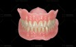 8.-acrylic-full-denture