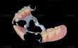 9.-partial-denture-CoCr-(1)