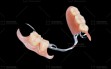 9.-partial-denture-CoCr-(2)
