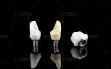 Calypso-Abutment2