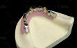 Digitek-Implant-Bar-1