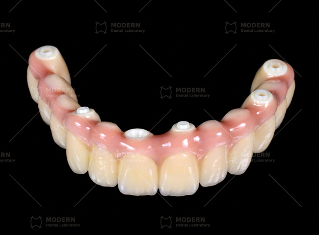 Digitek-Implant-Hybrid-bridge-2