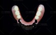 DuraFlex-Flexible-Partial-Denture