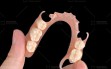 DuraFlex-Flexible-Partial-Denture-(2)