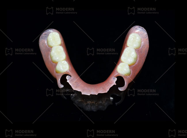 DuraFlex-Flexible-Partial-Denture