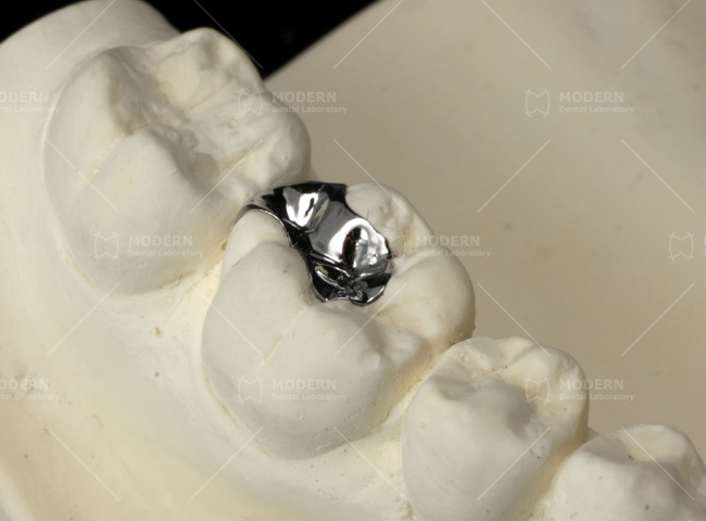 Full-Cast-Metal--metal-inlay