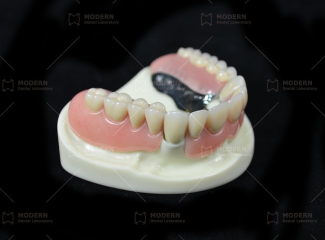 Telescopic-Crowns-and-Dentures-(1)
