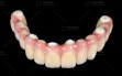 Digitek-Implant-Hybrid-bridge-2