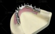 Digitek-Implant-hybrid-Bridge-1
