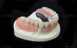 Telescopic-Crowns-and-Dentures-(1)