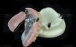 Telescopic-Crowns-and-Dentures-(2)