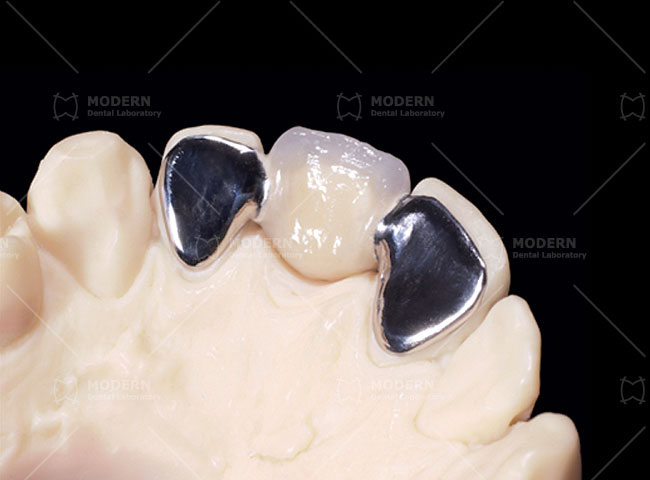 Porcelain-Fused-to-Metal (PFM) | Modern Dental Lab