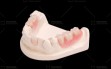Resure-Partial-Denture-2